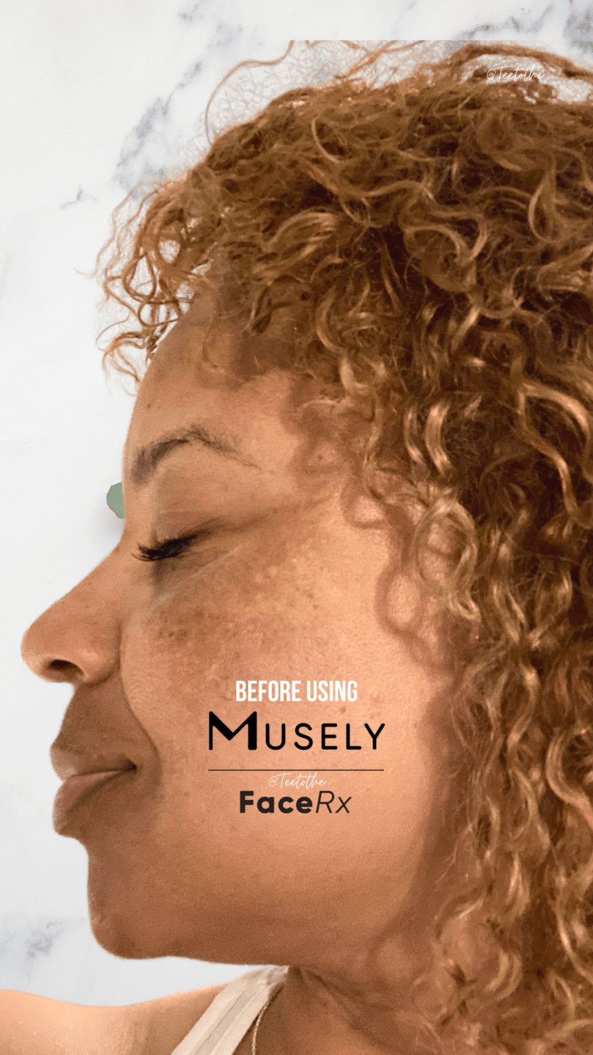 My Skincare Journey How I Cleared My Melasma Using Musely Teetothe