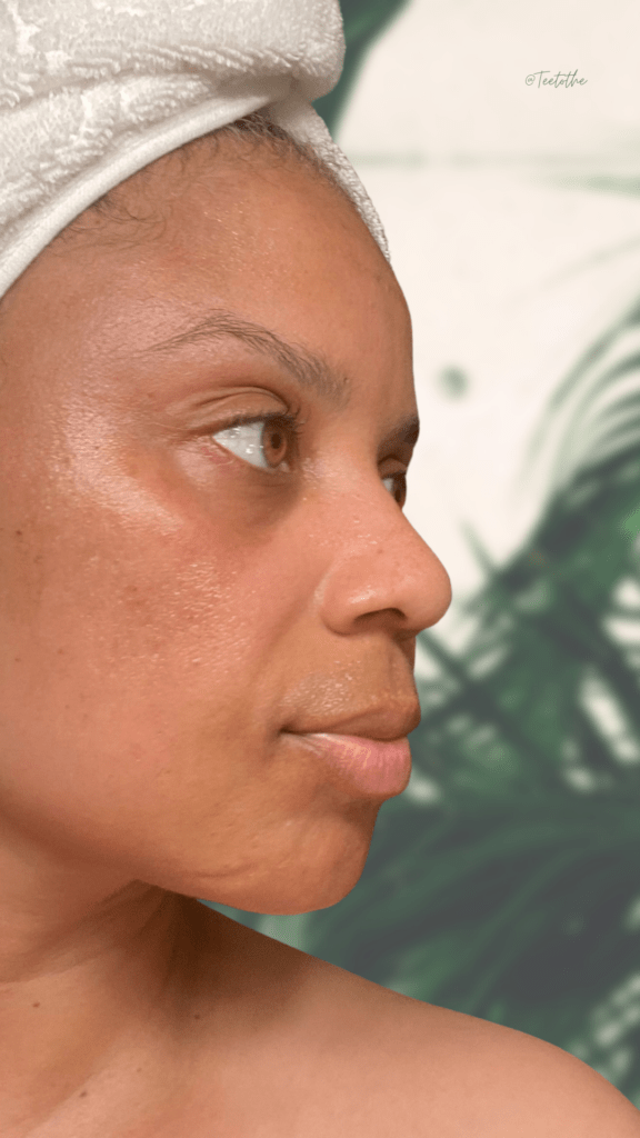 Melasma after using Musely for almost one year.