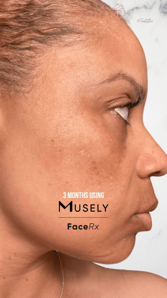 Melasma after using Musely for 3 months