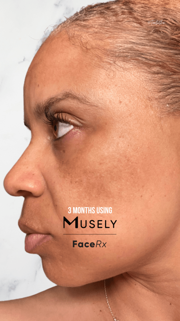 Melasma after using Musely for 3 months